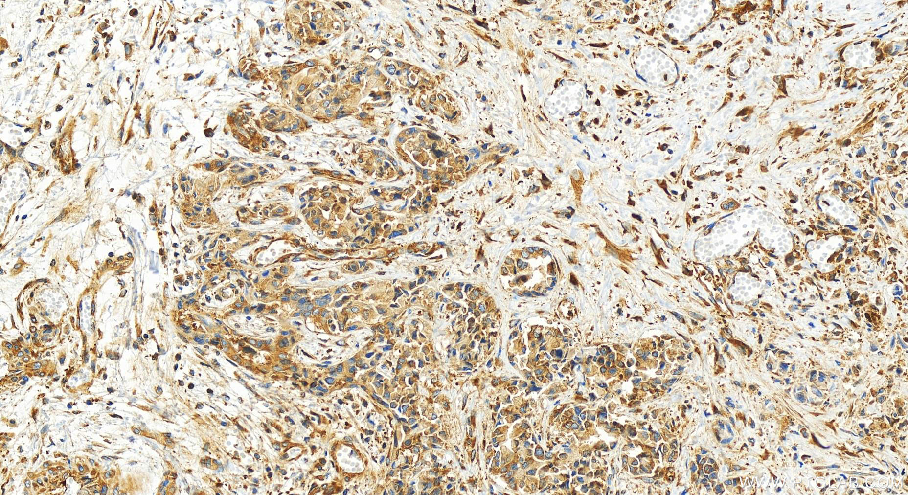 IHC staining of human intrahepatic cholangiocarcinoma using 83497-1-RR