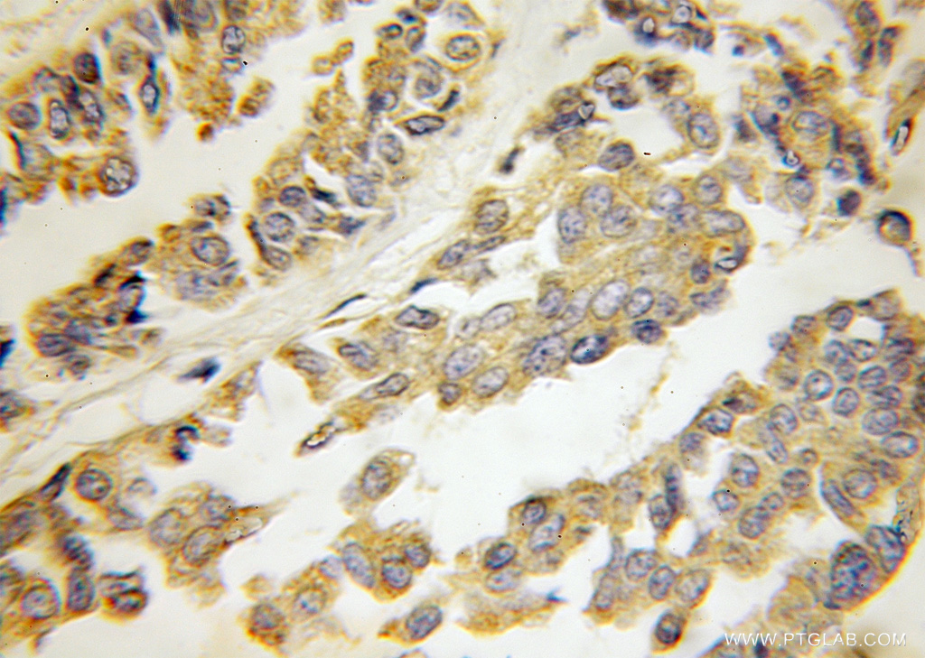 IHC staining of human breast cancer using 11301-1-AP