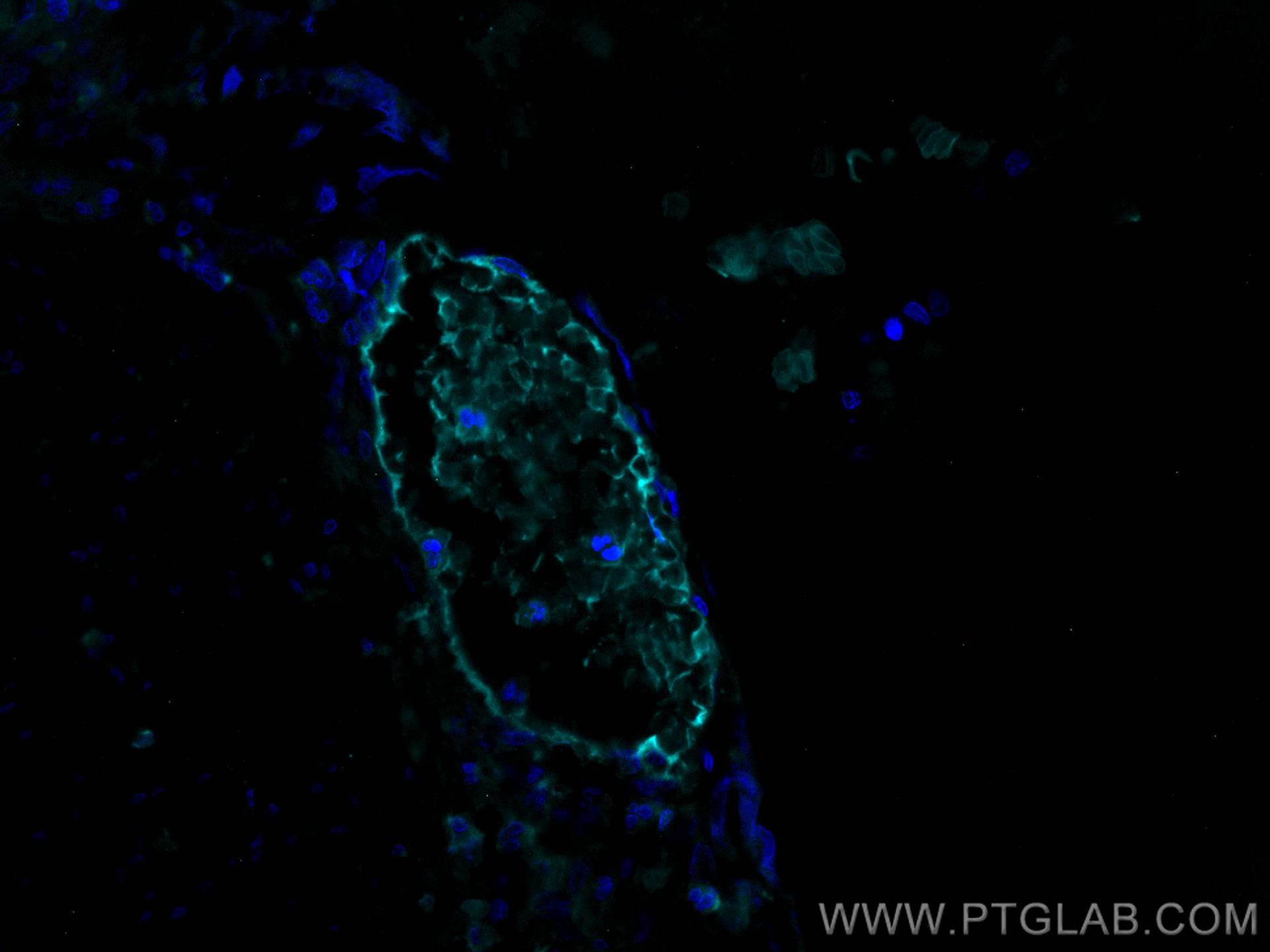 IF Staining of human appendicitis using CL750-16216