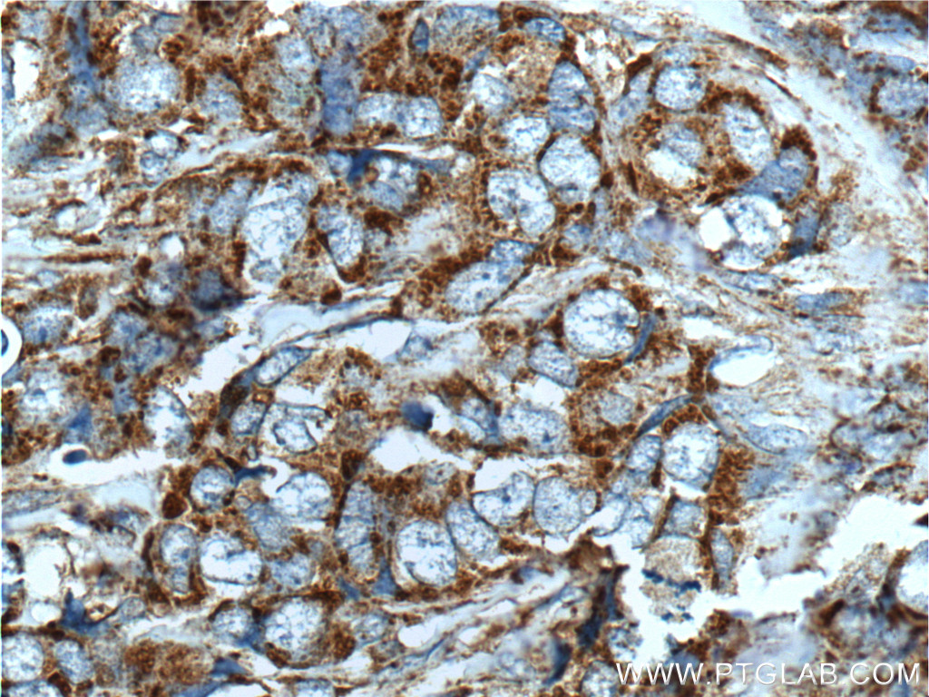 IHC staining of human breast cancer using 14492-1-AP