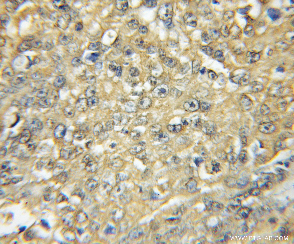 IHC staining of human lung cancer using 11600-1-AP