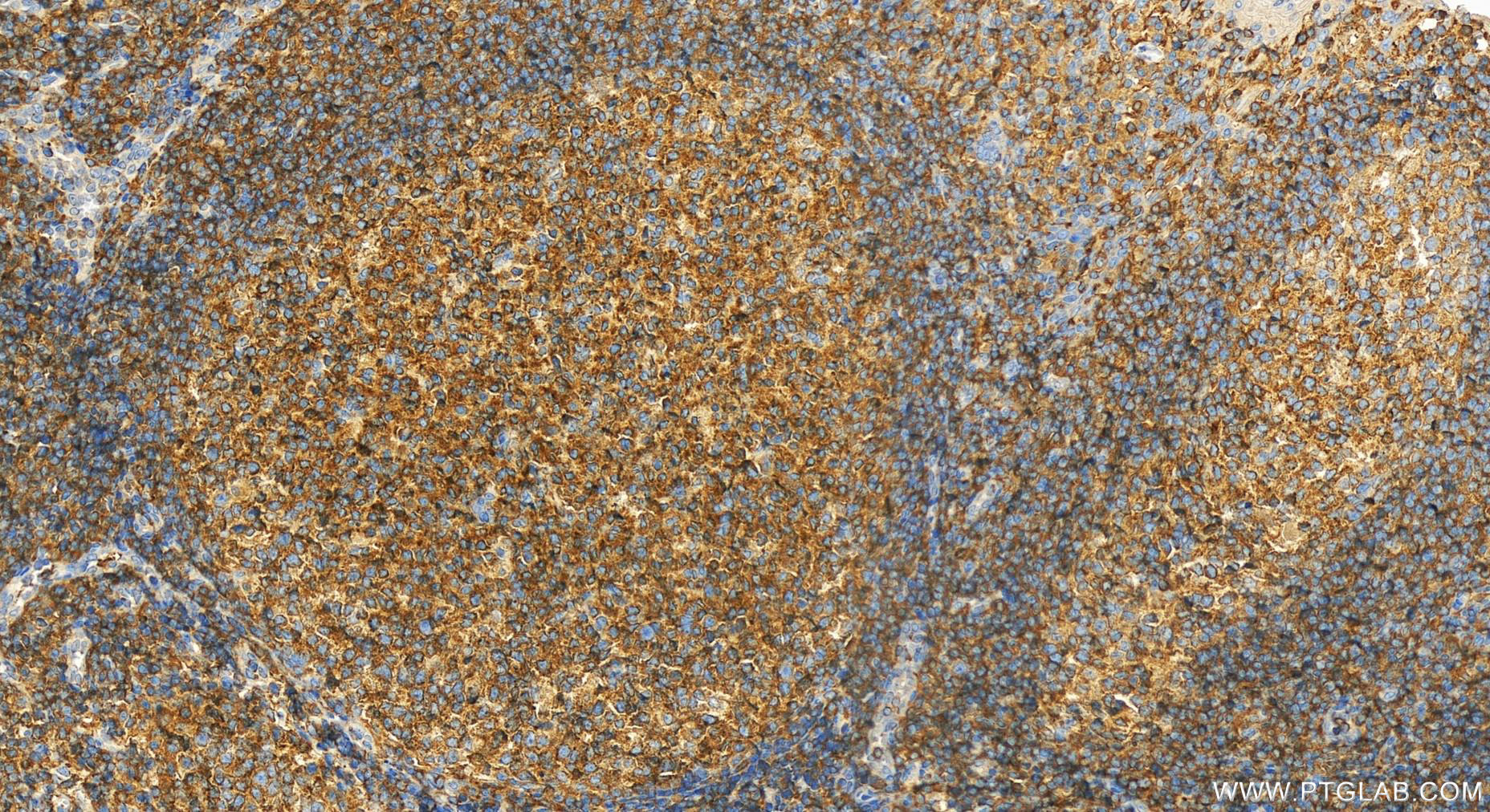 IHC staining of human tonsillitis using 25003-1-AP