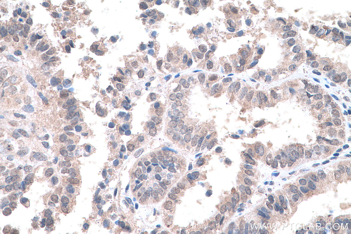 IHC staining of human ovary tumor using 67949-1-Ig (same clone as 67949-1-PBS)