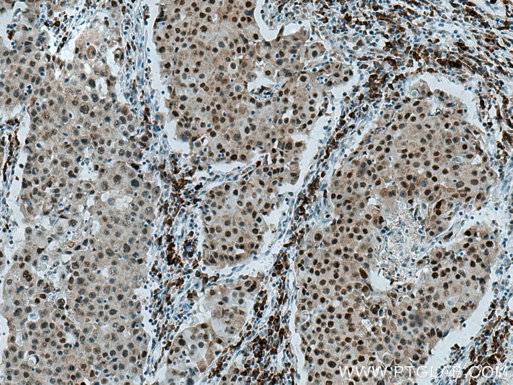 IHC staining of human breast cancer using 67165-1-Ig (same clone as 67165-1-PBS)