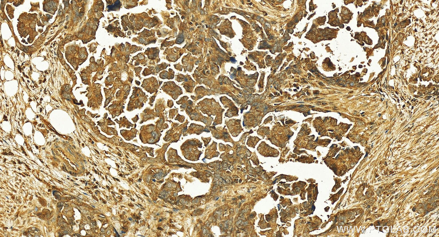 IHC staining of human ovary cancer using 16165-1-AP