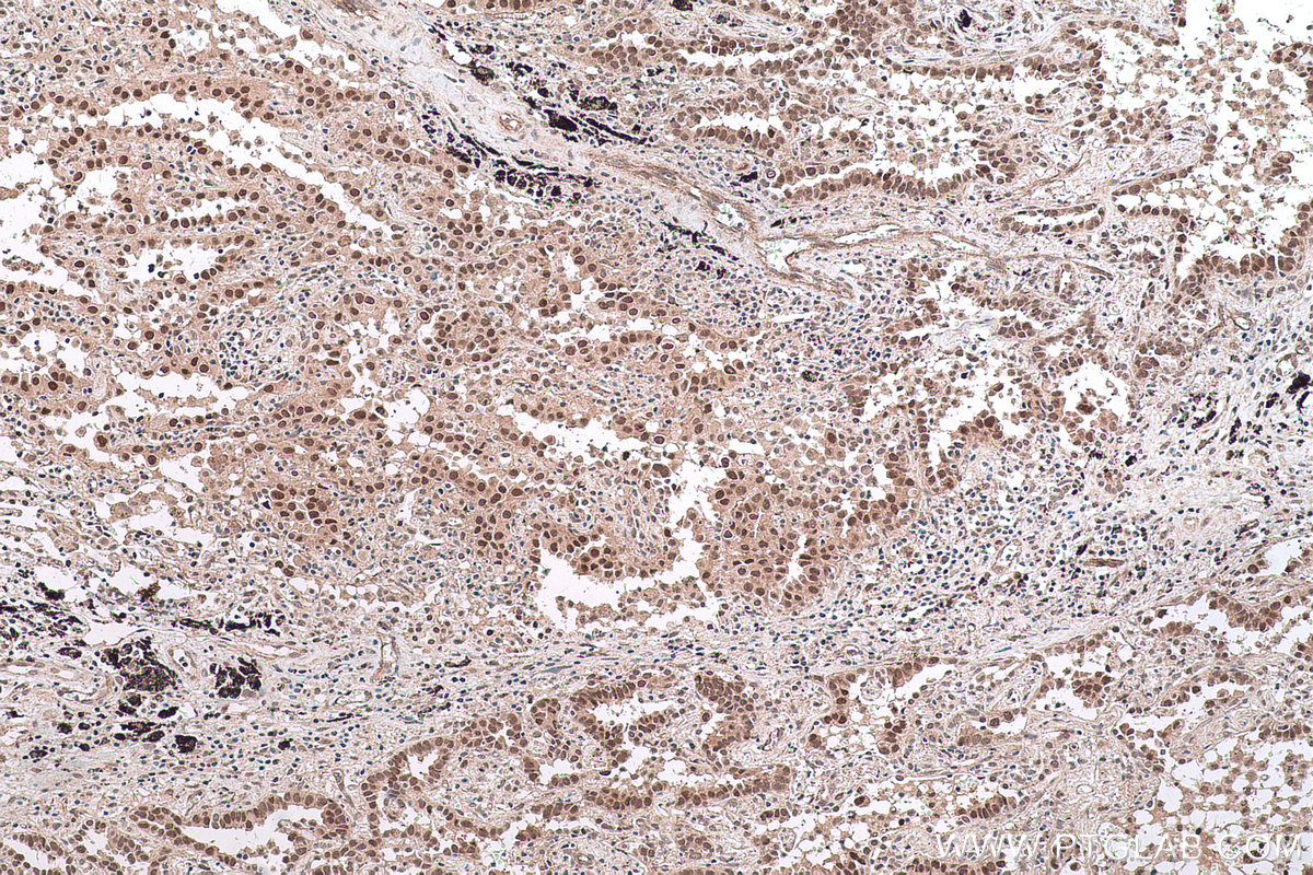 IHC staining of human lung cancer using 17548-1-AP