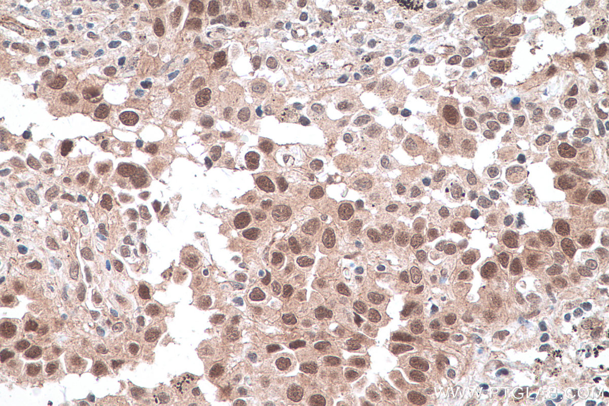 IHC staining of human lung cancer using 17548-1-AP