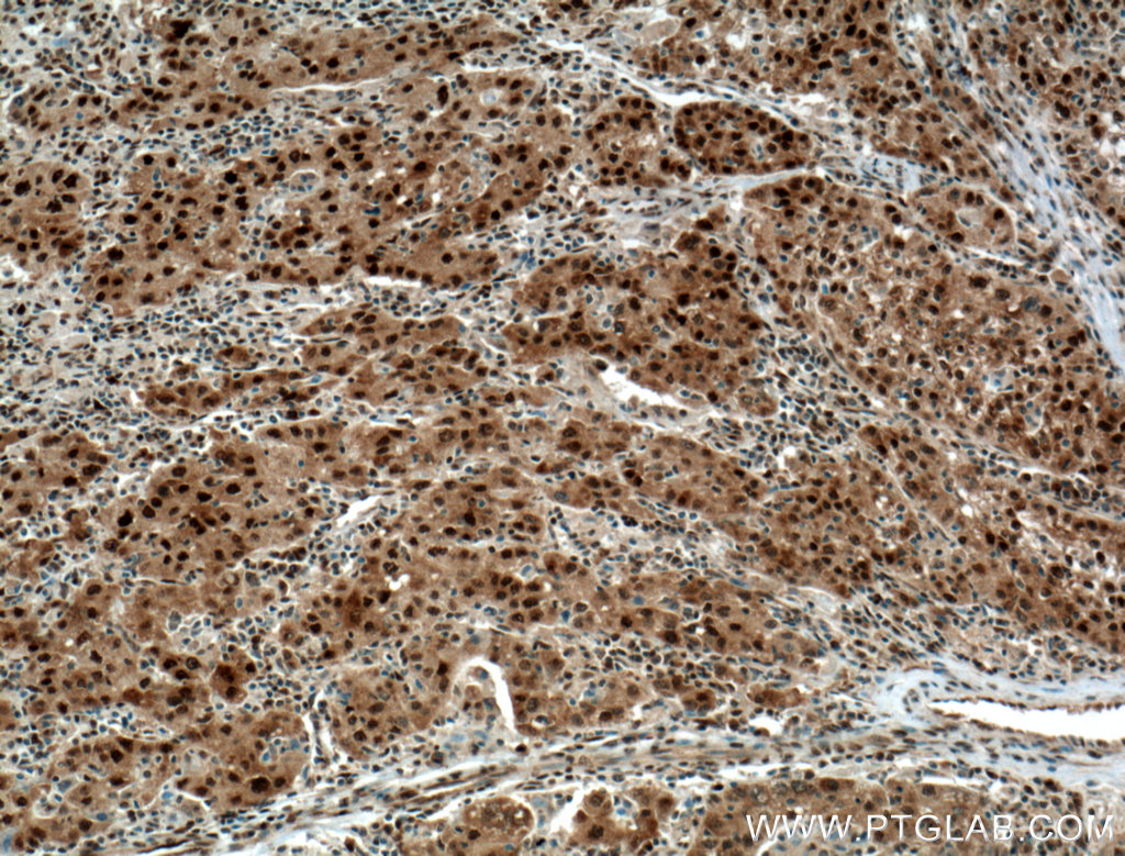 IHC staining of human liver cancer using 60064-1-Ig