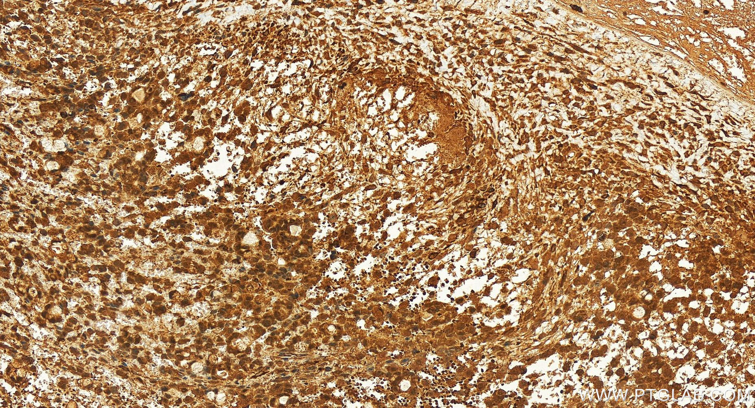 IHC staining of human ovary cancer using 27335-1-AP