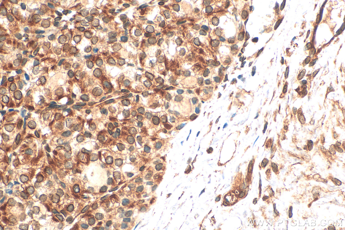 IHC staining of human thyroid cancer using 20960-1-AP