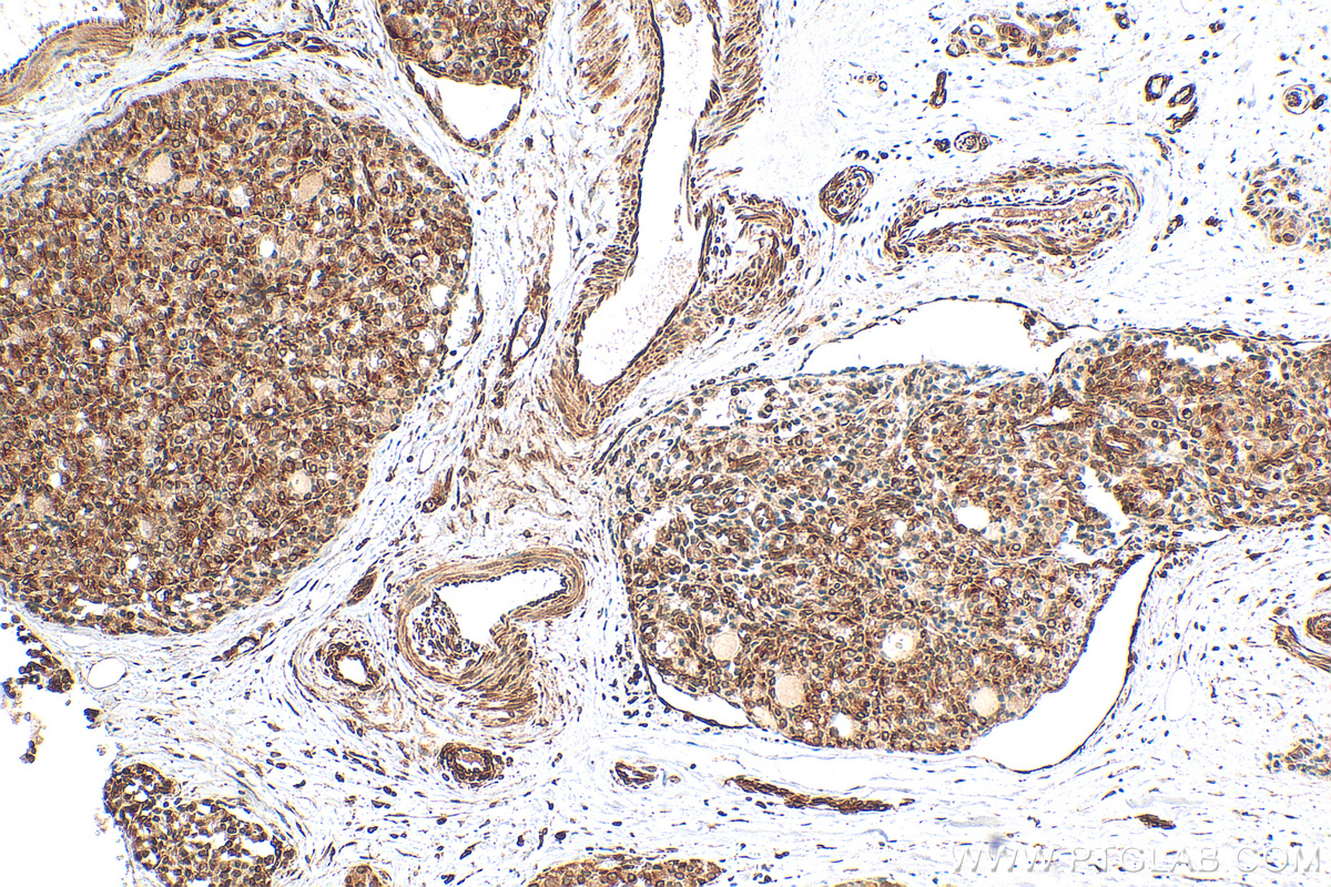 IHC staining of human thyroid cancer using 20960-1-AP