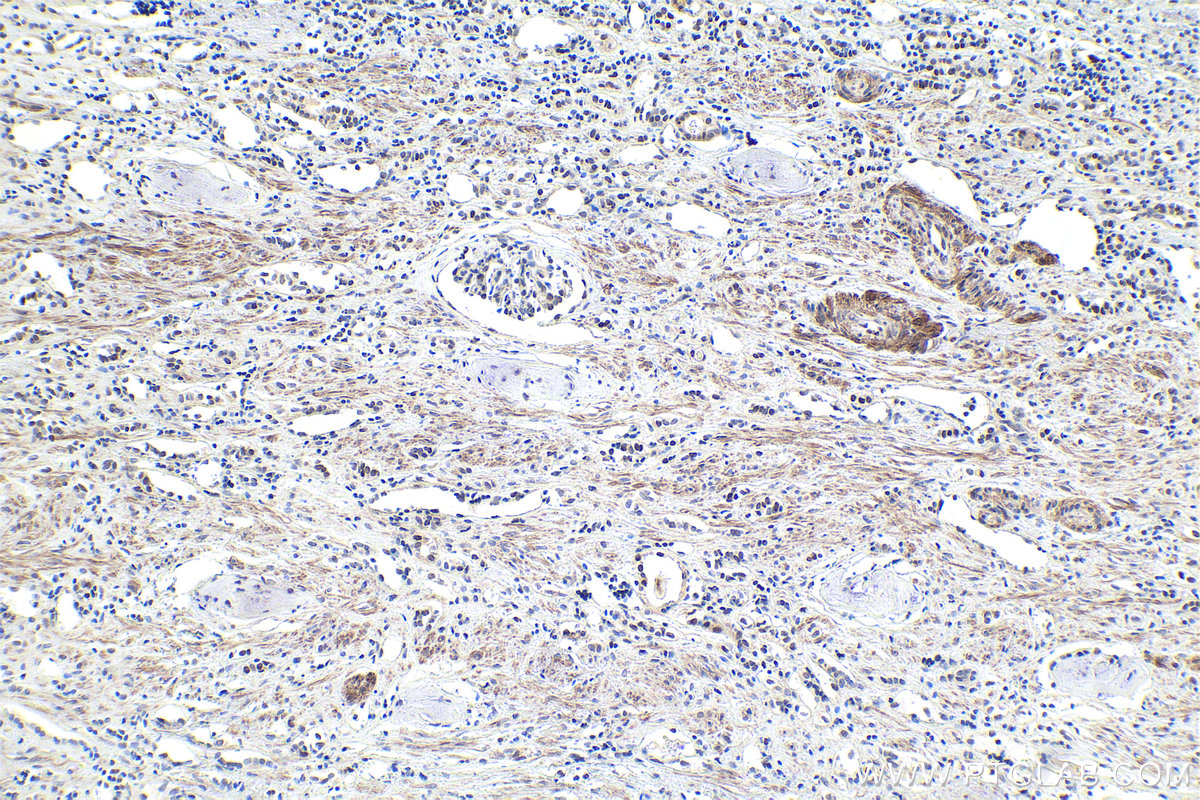 IHC staining of human renal cell carcinoma using 55408-1-AP