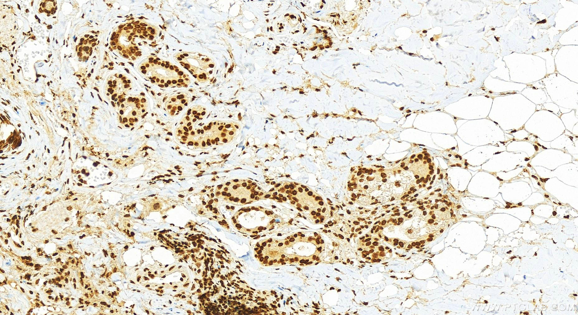 IHC staining of human skin cancer using 15953-1-AP