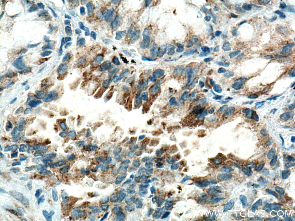 IHC staining of human lung cancer using 67803-1-Ig (same clone as 67803-1-PBS)