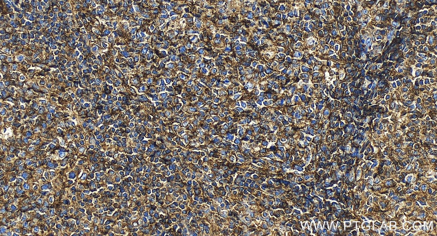 IHC staining of human tonsillitis using 15240-1-AP