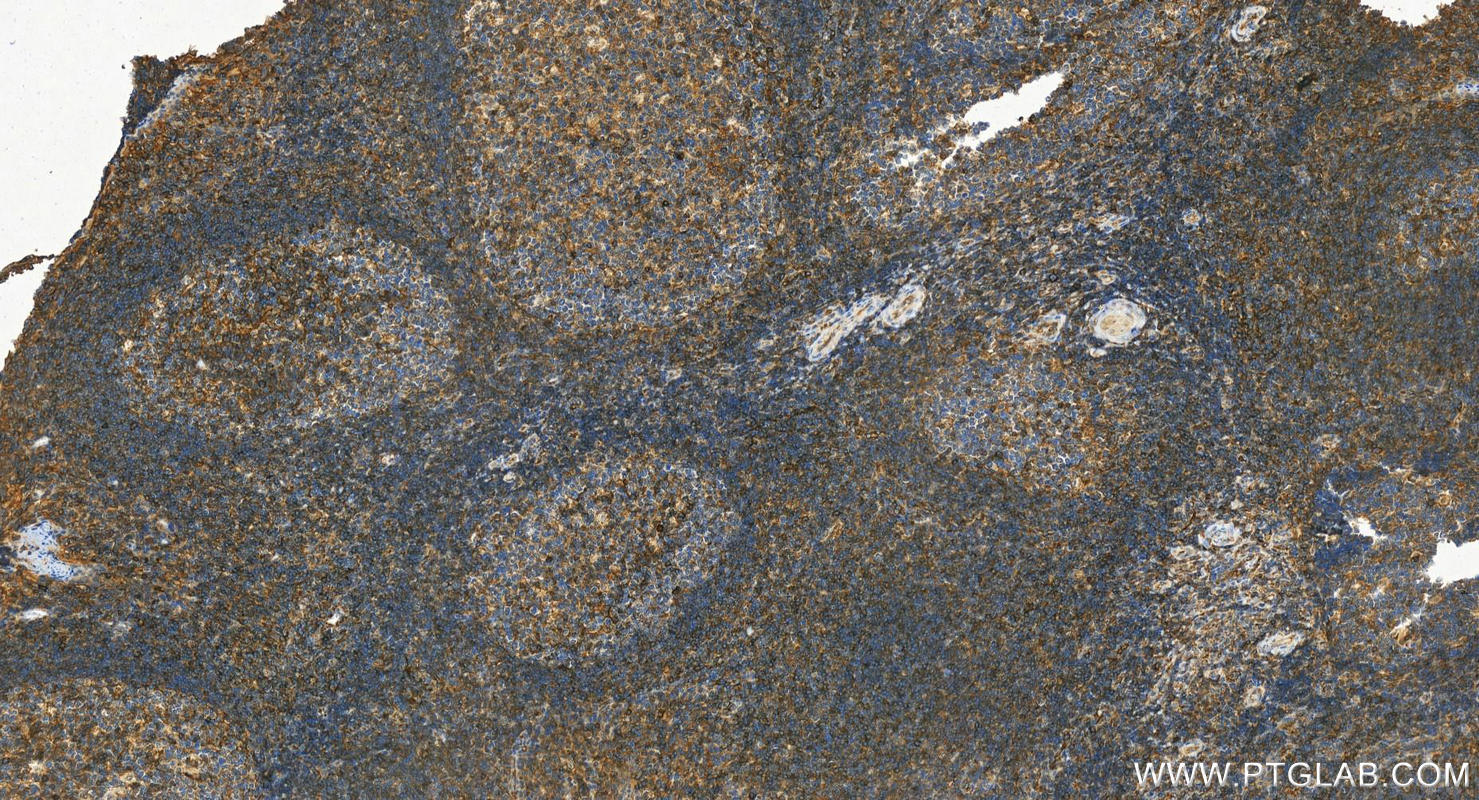 IHC staining of human tonsillitis using 55383-1-AP