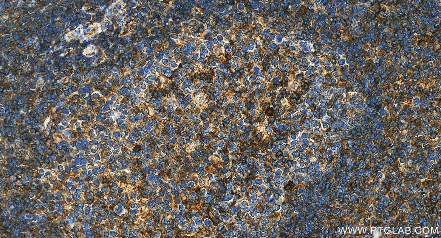 IHC staining of human tonsillitis using 55383-1-AP