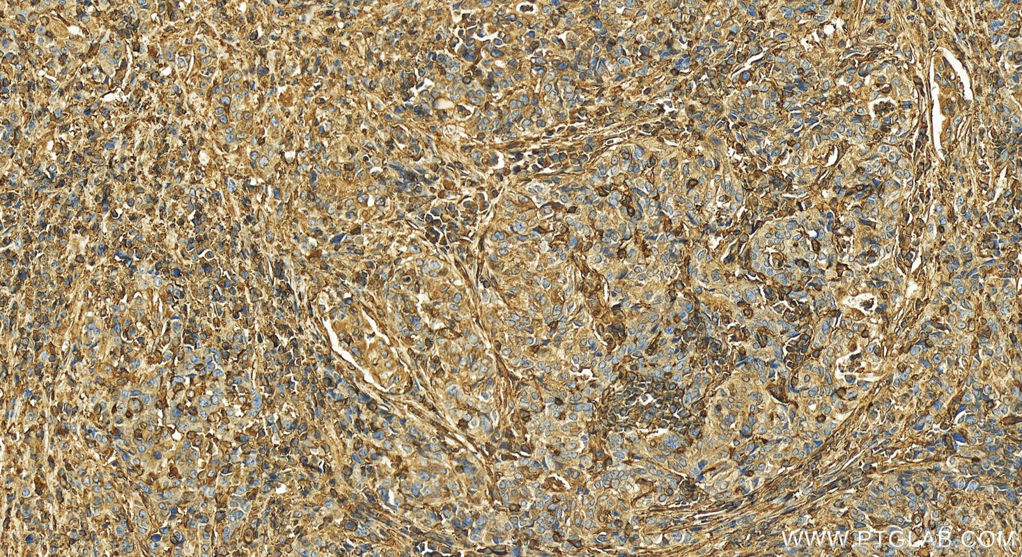 IHC staining of human stomach cancer using 17260-1-AP (same clone as 17260-1-PBS)