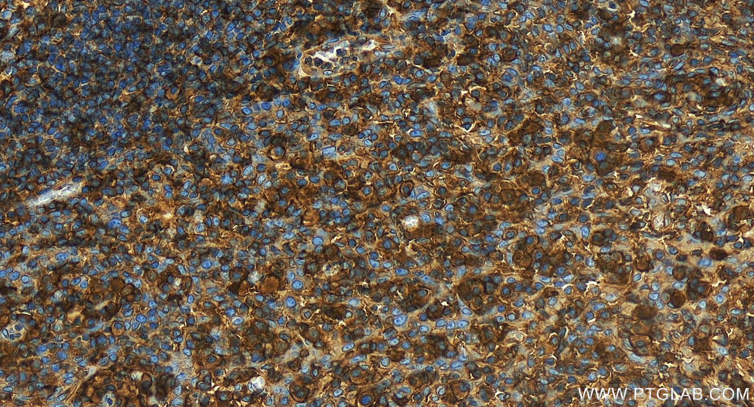 IHC staining of human tonsillitis using 15777-1-AP