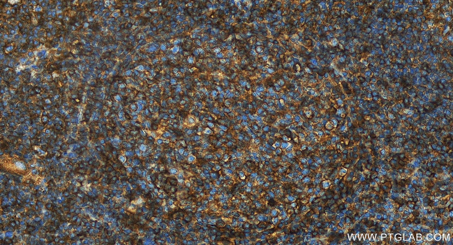 IHC staining of human tonsillitis using 15777-1-AP