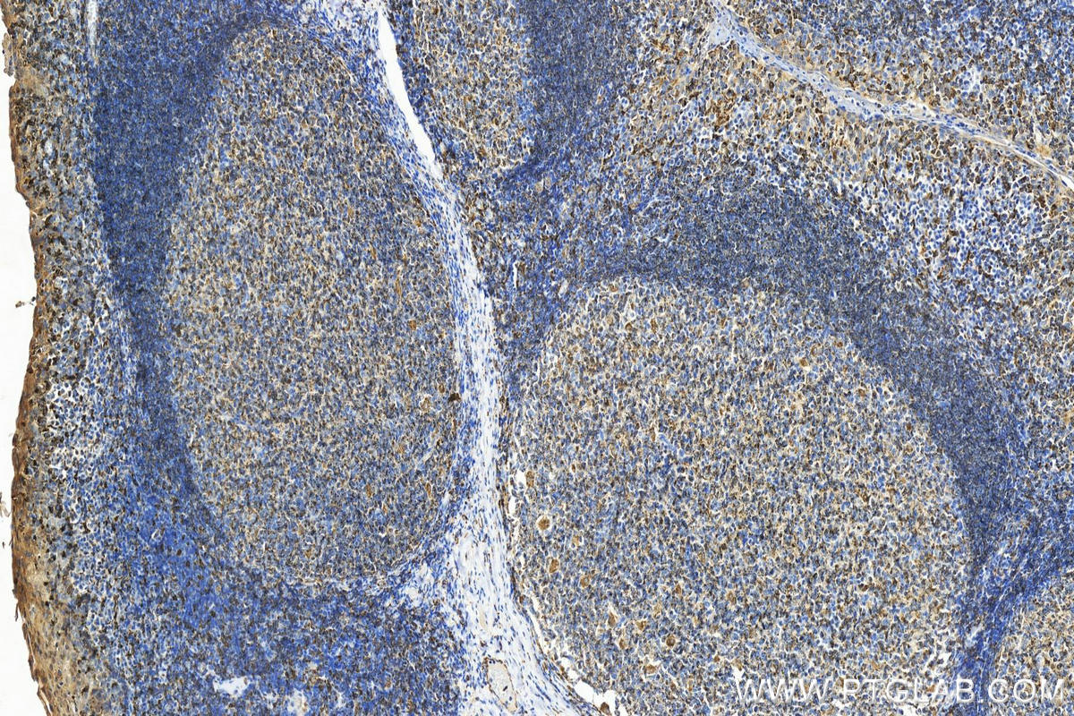 IHC staining of human tonsillitis using 21704-1-AP