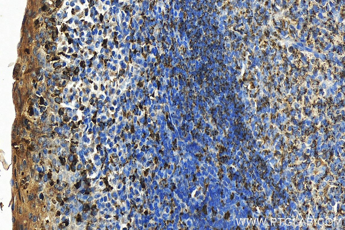 IHC staining of human tonsillitis using 21704-1-AP