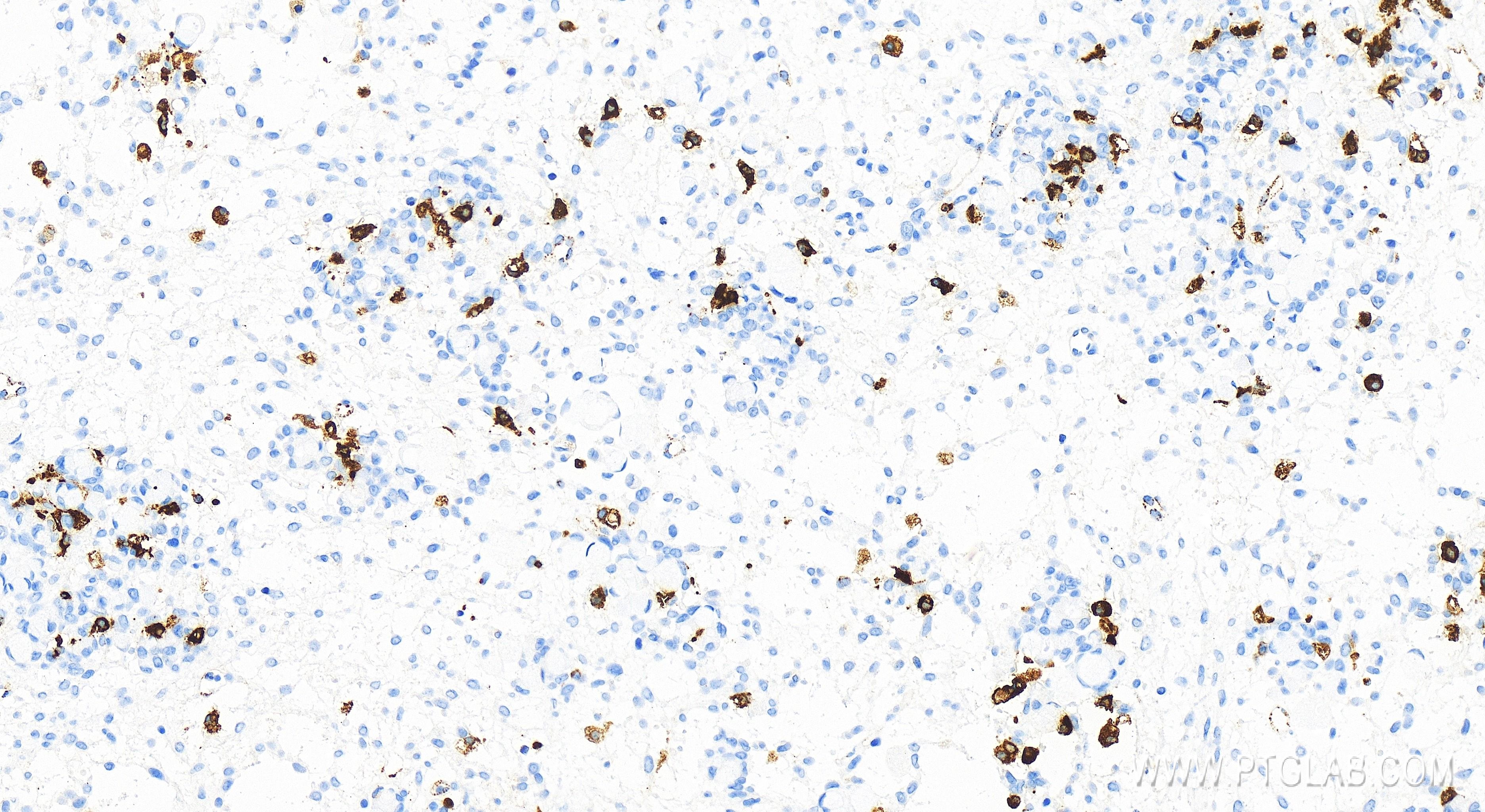 IHC staining of human ovary cancer using 82922-1-RR (same clone as 82922-1-PBS)