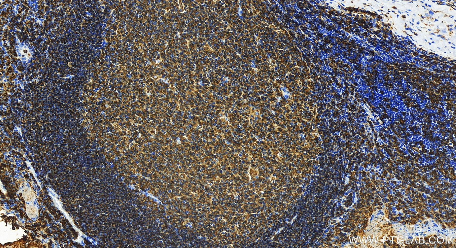 IHC staining of human tonsillitis using 83103-1-RR