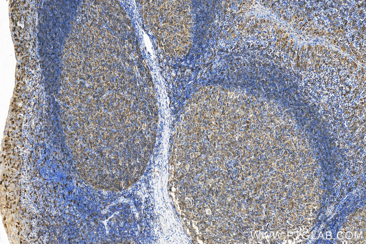 IHC staining of human tonsillitis using 21702-1-AP