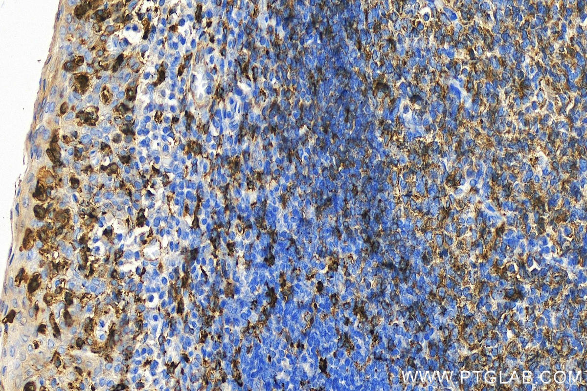 IHC staining of human tonsillitis using 21702-1-AP