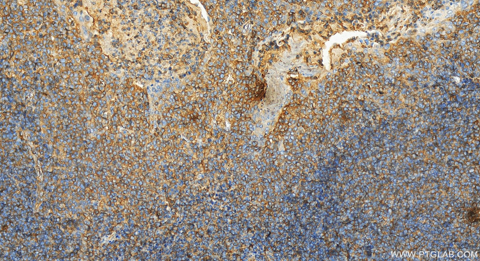 IHC staining of human tonsillitis using 14670-1-AP