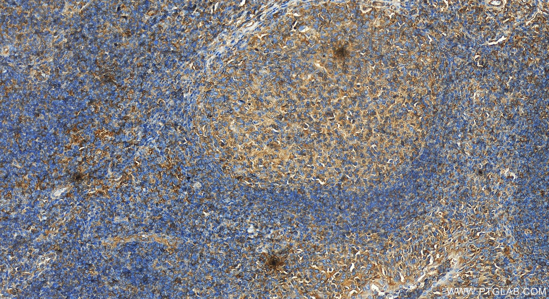 IHC staining of human tonsillitis using 14670-1-AP