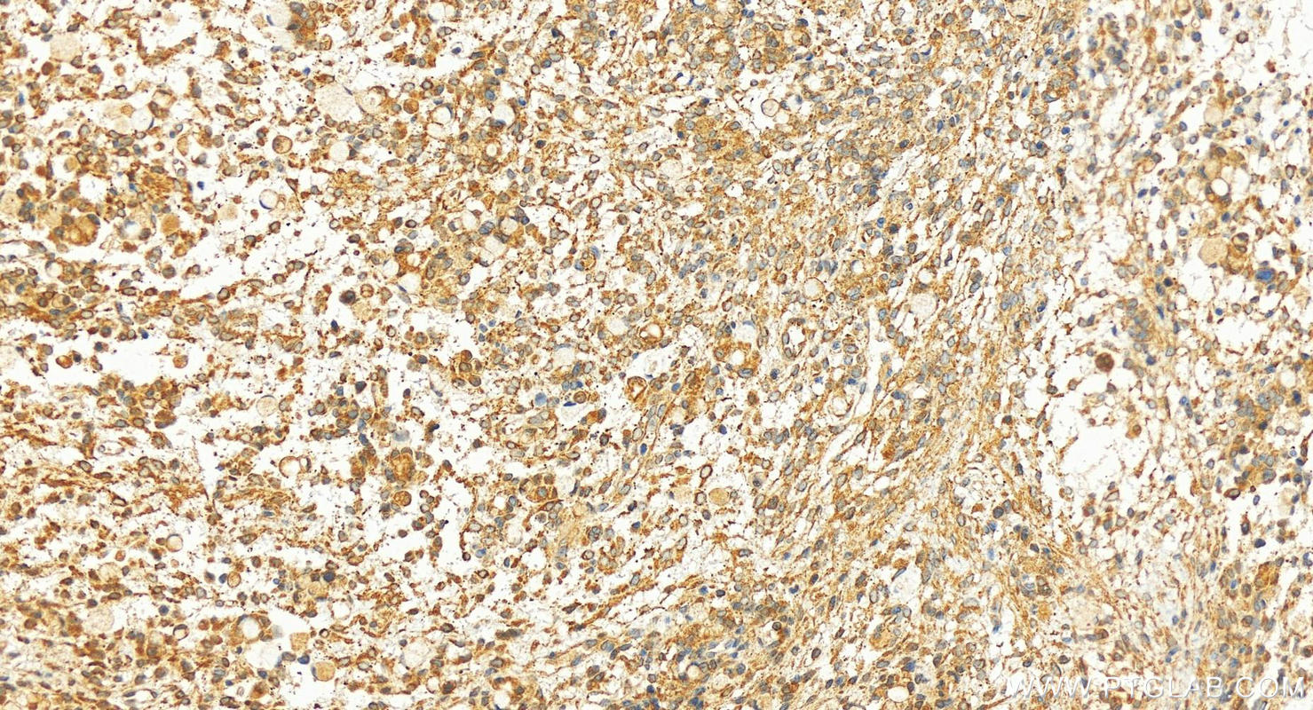 IHC staining of human ovary cancer using 14046-1-AP