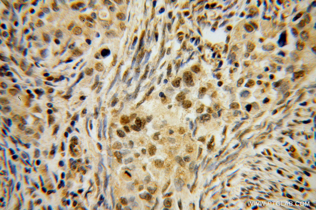 IHC staining of human endometrial cancer using 14336-1-AP