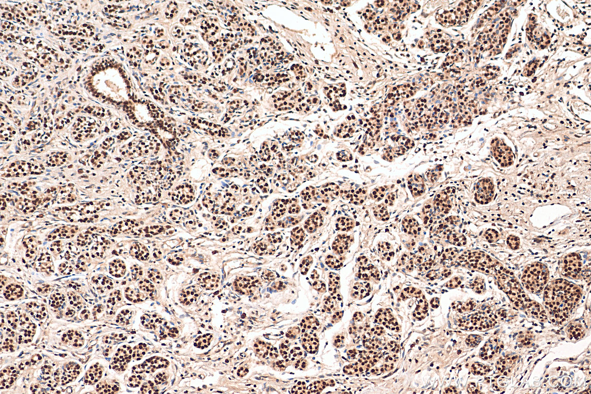 IHC staining of human breast cancer using 29895-1-AP (same clone as 29895-1-PBS)