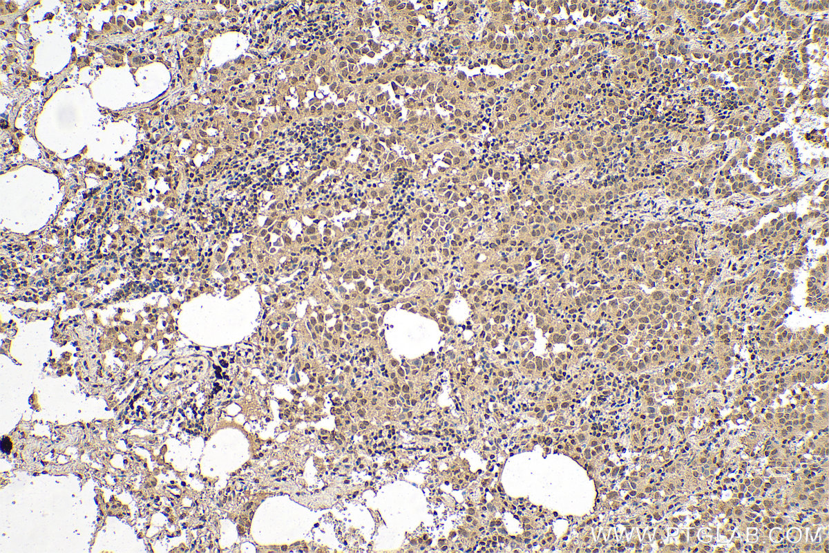 IHC staining of human lung cancer using 68185-1-Ig (same clone as 68185-1-PBS)