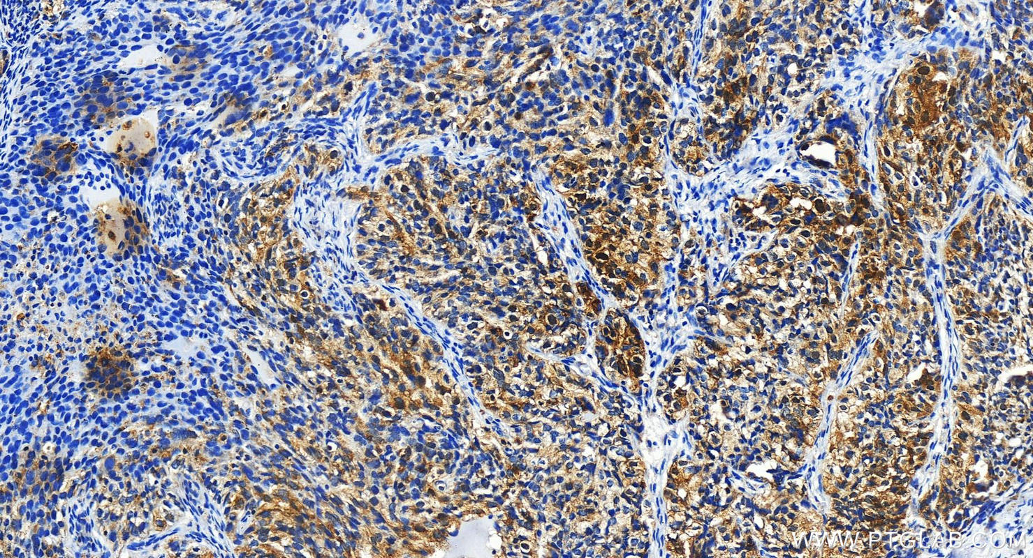 IHC staining of human ovary cancer using 17643-1-AP