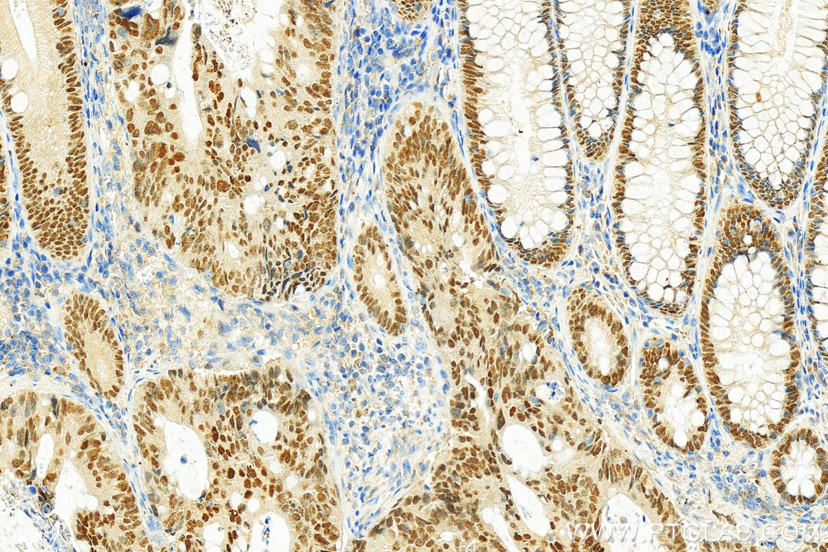 IHC staining of human colon cancer using 26245-1-AP