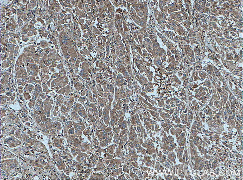 IHC staining of human liver cancer using 11874-1-AP