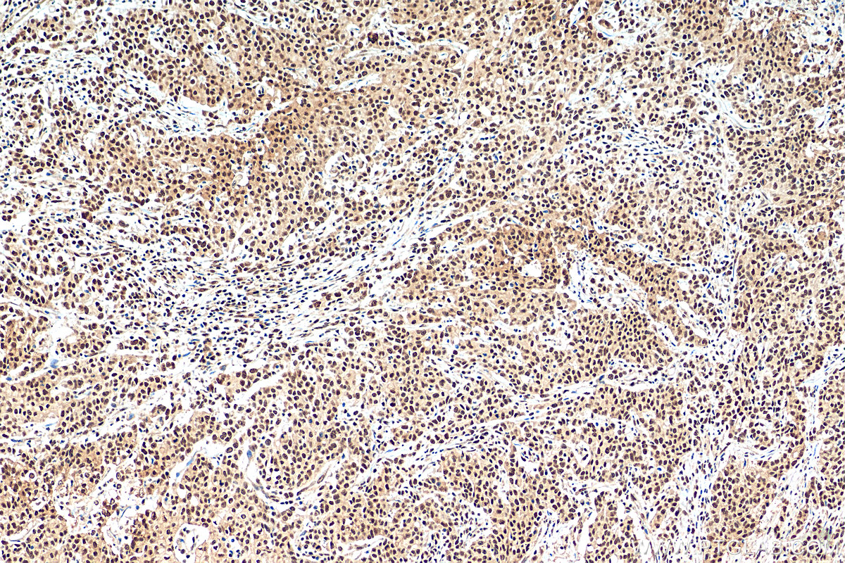 IHC staining of human stomach cancer using 82259-1-RR (same clone as 82259-1-PBS)