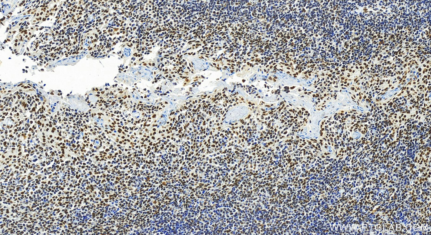 IHC staining of human tonsillitis using 26897-1-AP