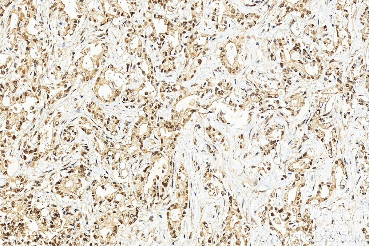 IHC staining of human intrahepatic cholangiocarcinoma using 10660-2-AP