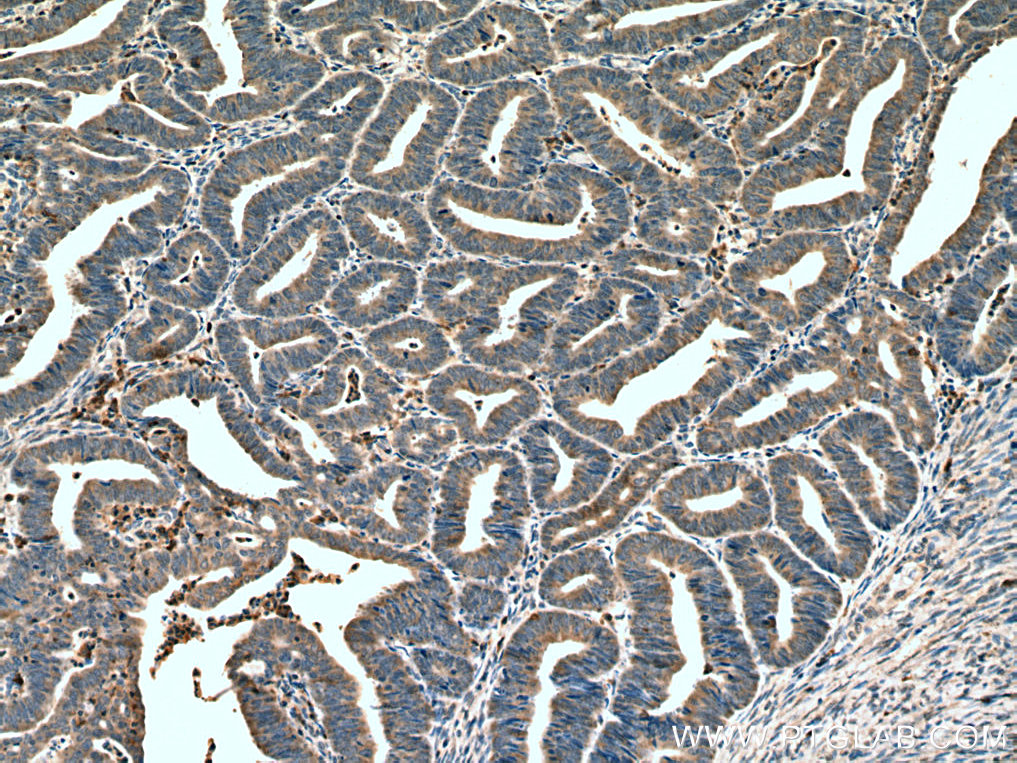 IHC staining of human endometrial cancer using 67377-1-Ig (same clone as 67377-1-PBS)