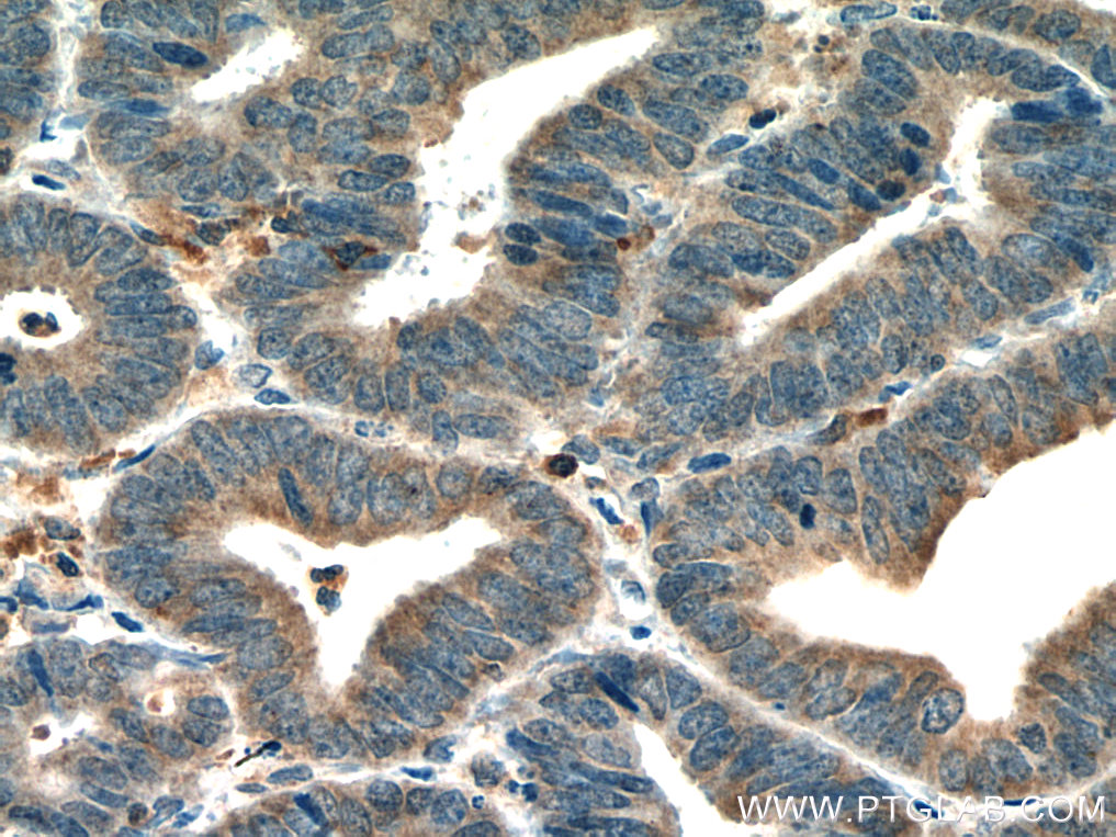 IHC staining of human endometrial cancer using 67377-1-Ig (same clone as 67377-1-PBS)