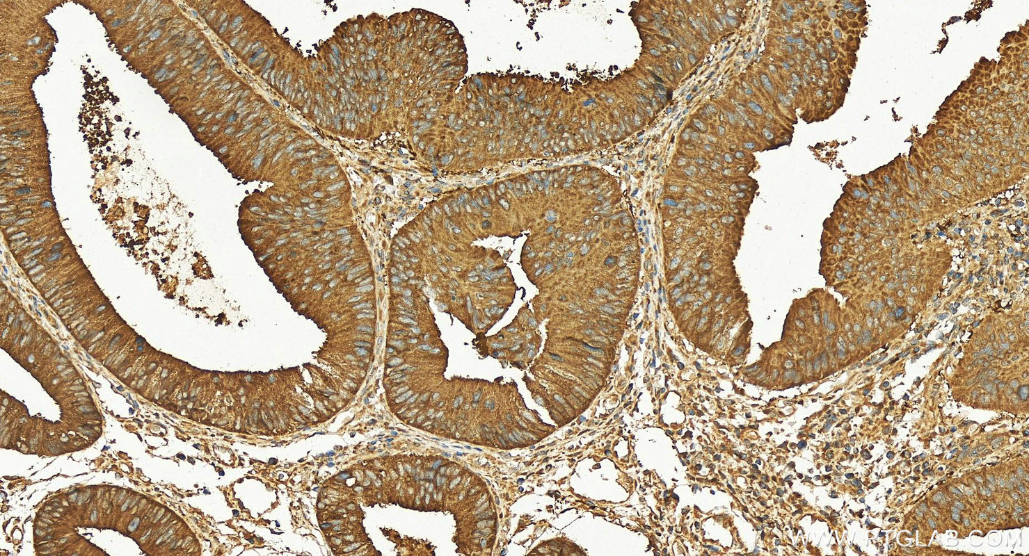 IHC staining of human colon cancer using 10871-1-AP