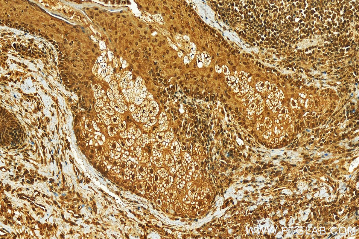 IHC staining of human skin cancer using 24556-1-AP