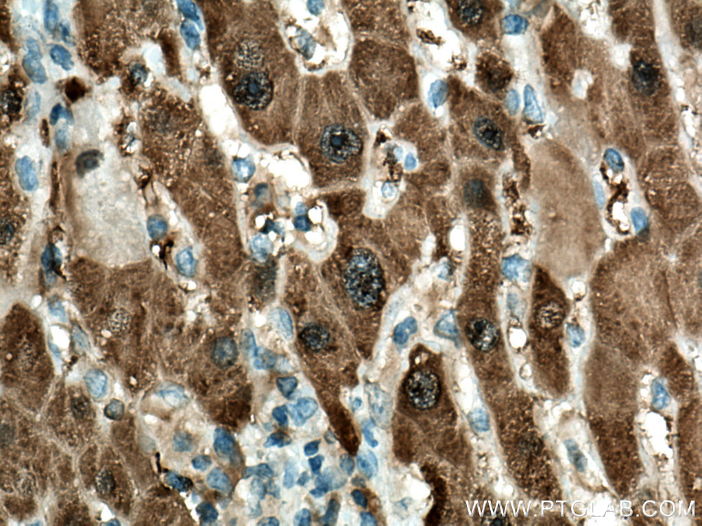 IHC staining of human liver cancer using 67552-1-Ig (same clone as 67552-1-PBS)