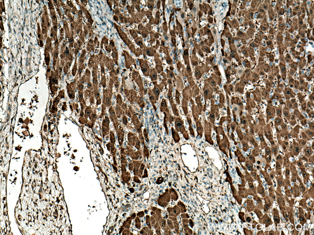 IHC staining of human liver cancer using 67552-1-Ig (same clone as 67552-1-PBS)