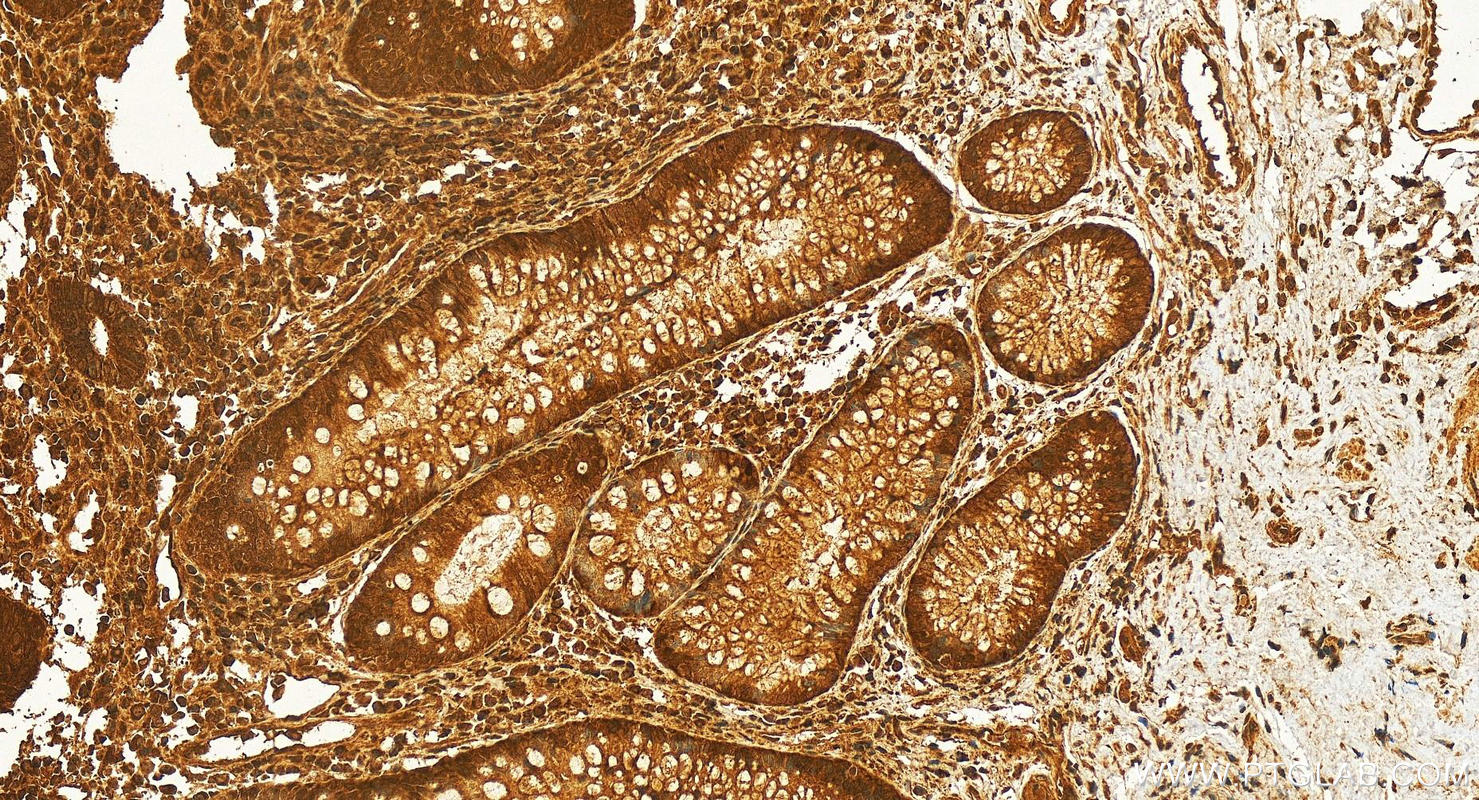 IHC staining of human colon cancer using 18295-1-AP