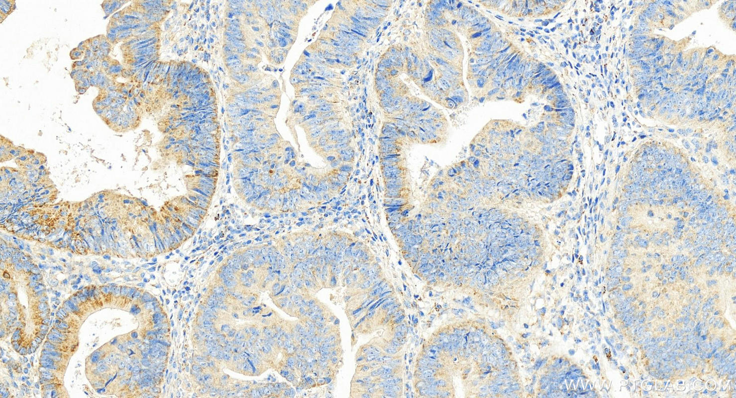 IHC staining of human colon cancer using 15132-1-AP